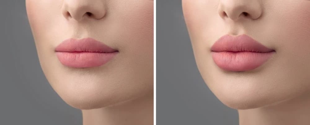 Before and After Lip Filler Injections