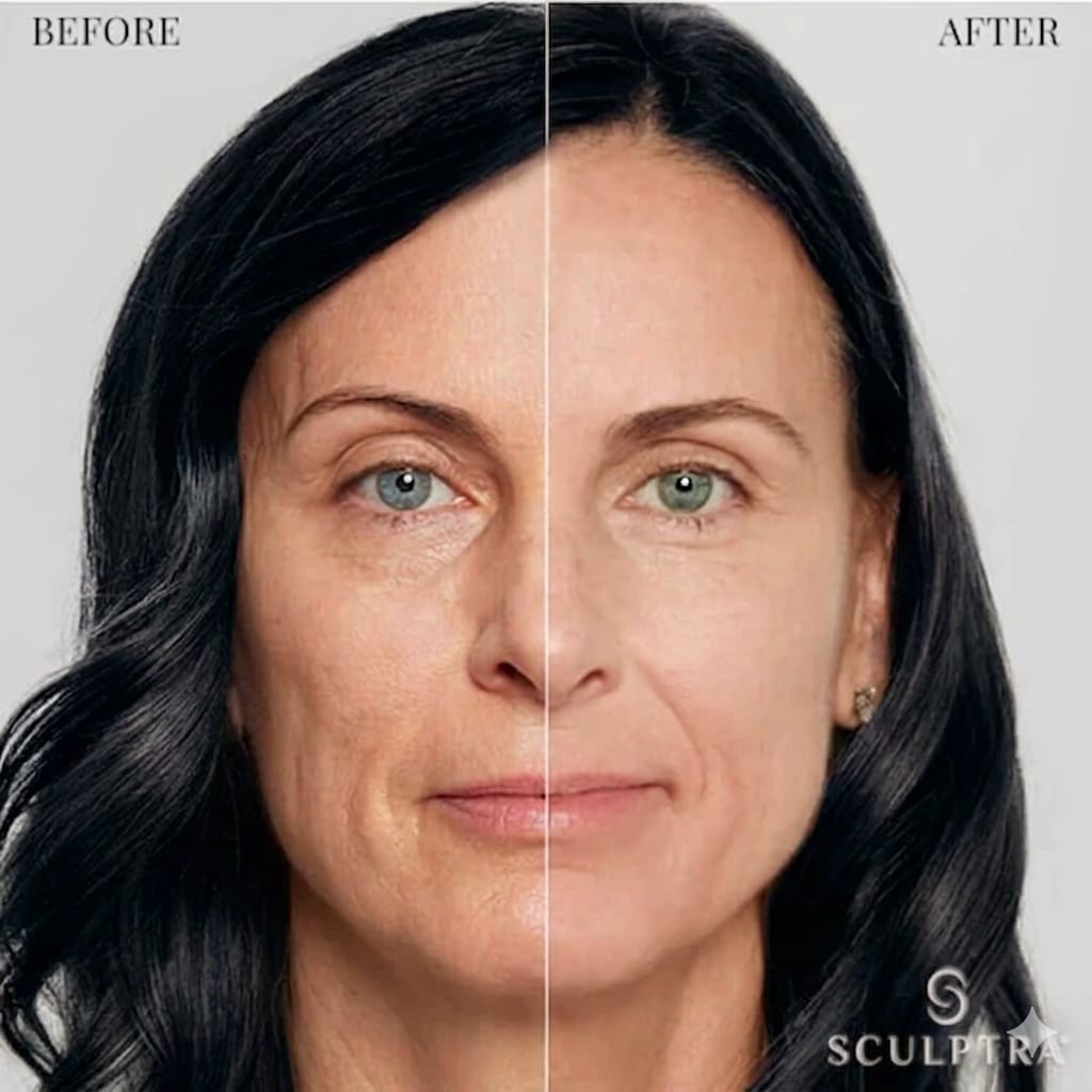 Before and after results of Sculptra aesthetic treatment