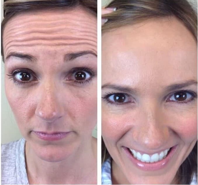 Before and after Botox for forehead lines