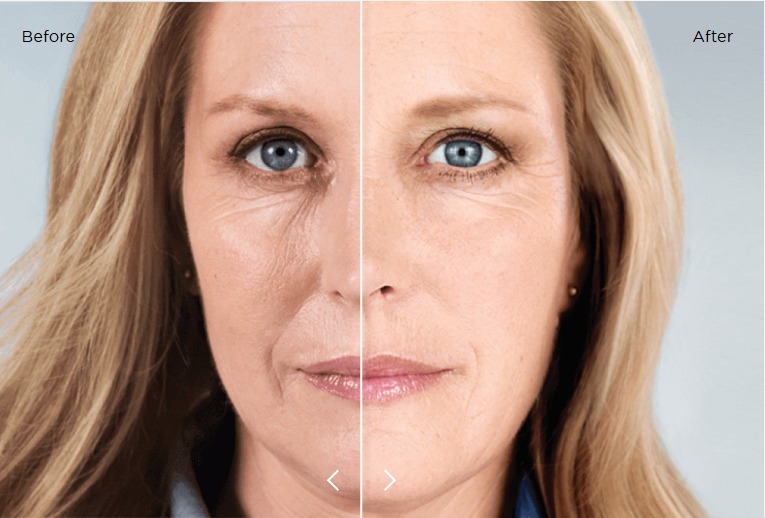 Sculptra® in Orlando, FL